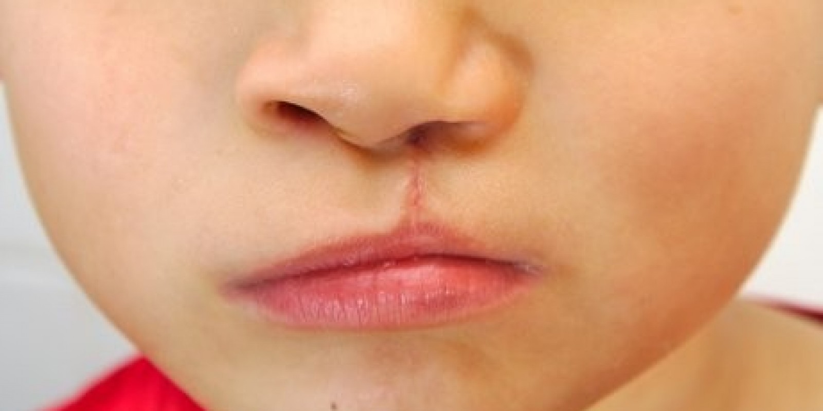 Lábio leporino: Dr. Álvaro Sá explica como funciona o tratamento das ...